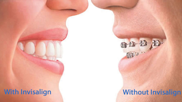 Invisalign in Red Bank